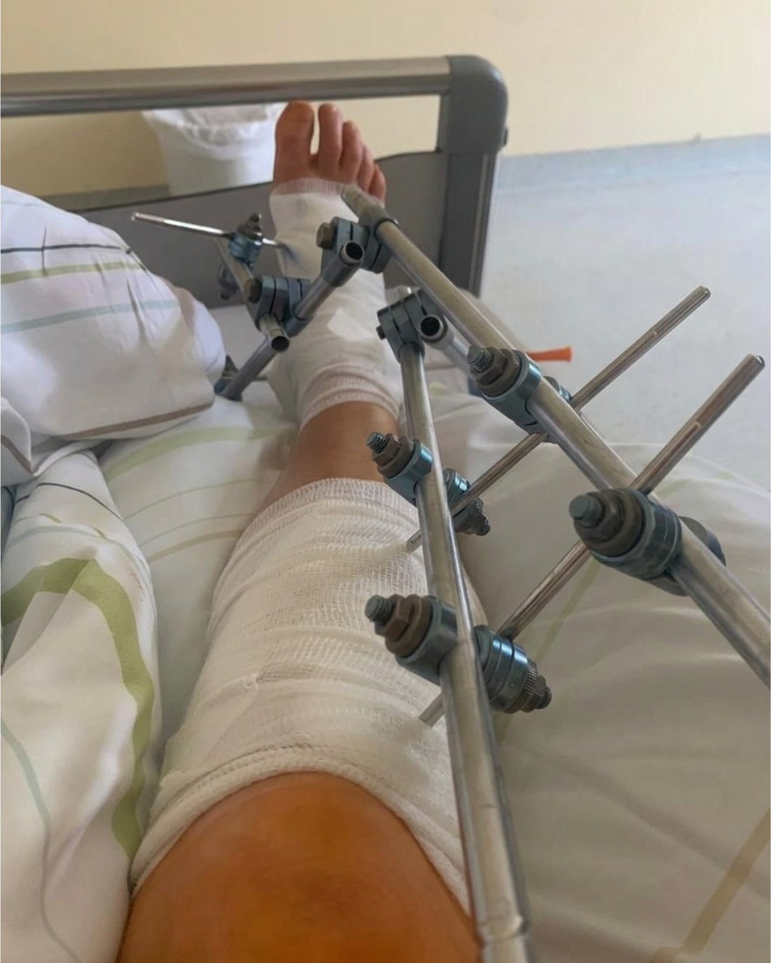Bein mit äußerem Fixateur im Krankenhaus nach mehreren Frakturen, 2025